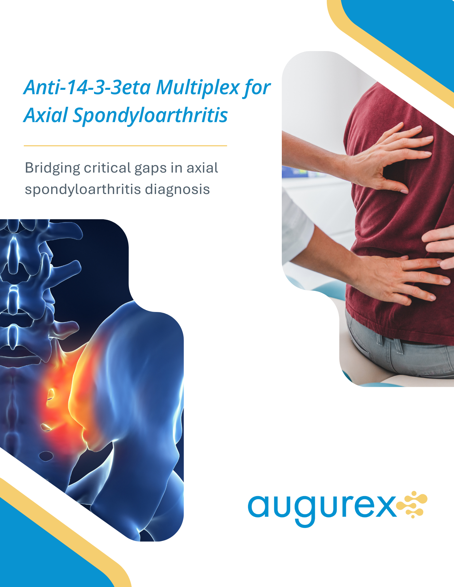Axial Spondyloarthritis [Archived] - Augurex